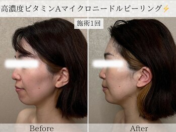 フラリ 西葛西(Hulali)/30代マイクロニードル1回目