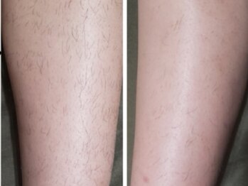 ルルトウキョウ 池袋店(LULU.tokyo)/ひざ下脱毛/1回目→3回目