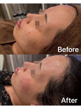 ライム 中野(LIME)/ハーブピーリング｜フェイシャル