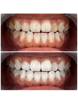 エクシアホワイトニング 日本橋店/ブライダルホワイトニング