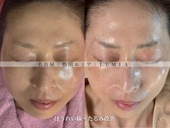 ルミア(LUMIA)の写真/たるみ・ほうれい線・フェイスラインにアプローチ！たるみ改善であなた史上最高の若見えリフトアップ◎
