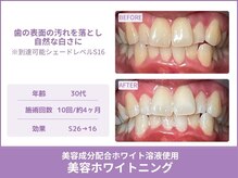 クレア(Crea)/【歯のホワイトニング症例写真】