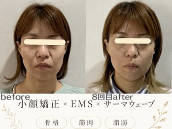 エスポワール(espoir)の写真/【エステ版オンダ最高峰】サーマウェーブ×ems×小顔矯正でほうれい線・たるみを最短リフト〈7800円〉