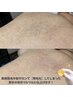 脱毛前より増えてしまった方！硬毛化対策に◎  背中 シュガーリング  ￥4,900