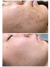 アンジェロ/【ニキビケア】肌育プログラム