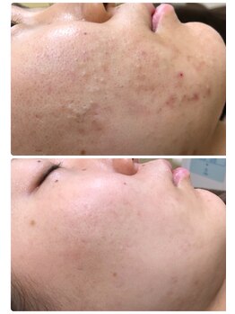 アンジェロ/【ニキビケア】肌育プログラム