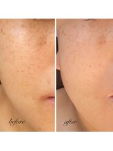 ルミア(Rumia)/【大人気♪】BBLフェイシャル♪