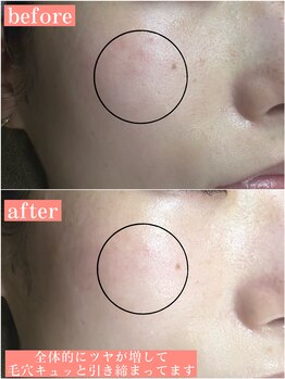 ティーツリー 名古屋 桜山(Tea Tree)/ツヤ感アップと毛穴がキュッ！