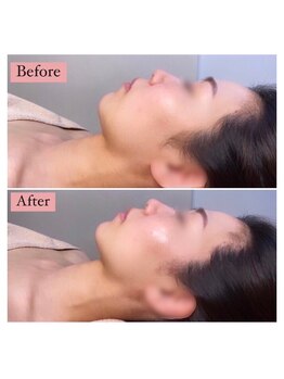 アンシャンテ(ENCHANTER)/お顔リフトアップ