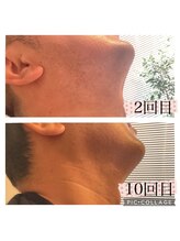 ゲッカ(GEKKA)/メンズひげ脱毛