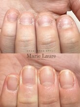 マリーロール 淀屋橋本店(Marie Laure)/自爪育成/深爪矯正/ネイルケア