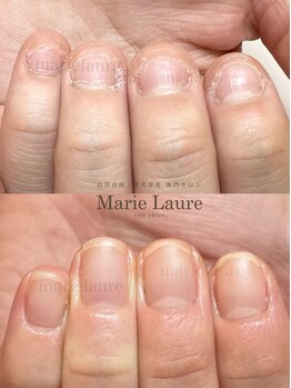 マリーロール 淀屋橋本店(Marie Laure)/自爪育成/深爪矯正/ネイルケア