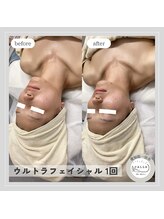 カラー(CALLA)/ウルトラ痩身で小顔ゲット！