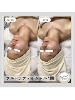 カラー(CALLA)/ウルトラ痩身で小顔ゲット！