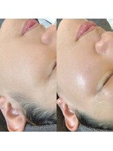 ルブール(levure)/WAX脱毛はたった1度でこの変化