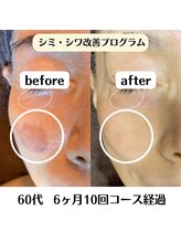 グラチア(Gratiae)/60代/シミ改善プログラム