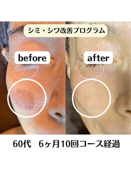グラチア(Gratiae)/60代/シミ改善プログラム