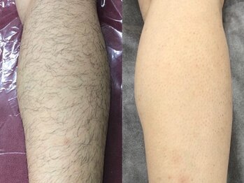 ルルトウキョウ 池袋店(LULU.tokyo)/ひざ下脱毛/1回目→9回目