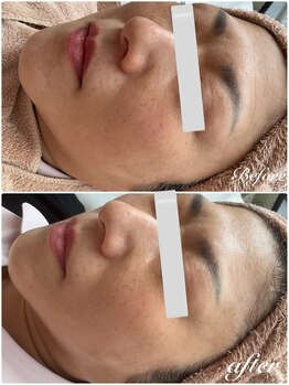 美バストアルファ(美bust α)/【シミケア】症例