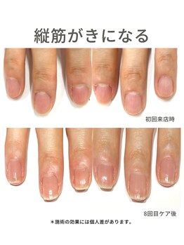 40代/縦筋/3ヶ月後アフター