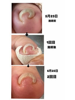 ココネイル(coconail)/巻き爪矯正