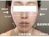 当日から-5才肌☆【プラズマ+光フェイシャル】プラズマでピーリング効果も♪