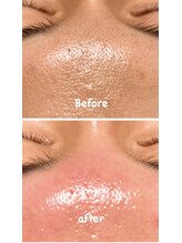 シャルム(charme)/フォト&ピーリング・鎮静パック