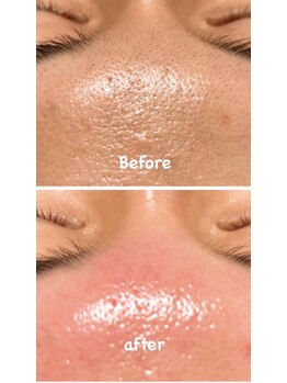 シャルム(charme)/フォト&ピーリング・鎮静パック