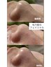 オプション【毛穴吸引orポレーション追加】←どちらかを追加したい方はこちら