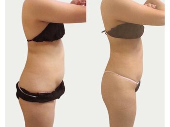ナナイロ 下郡店(nanairo)の写真/徹底的に気になる脂肪を燃焼&分解！セルフケアでは難しいセル脂肪を撃退してメリハリBODYへ☆