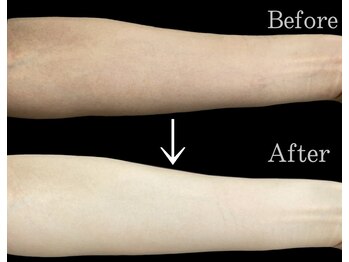 リブ(Lib)/ニキビケアにも◎