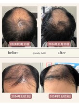 スカルプラボ 倉敷店(Scalp Lab)/moumitu症例8ヶ月