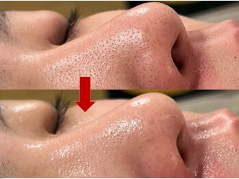 ブリリアン デイスパ 阪急西宮ガーデンズ店(BRILLIAN DAYSPA)/毛穴洗浄フェイシャル