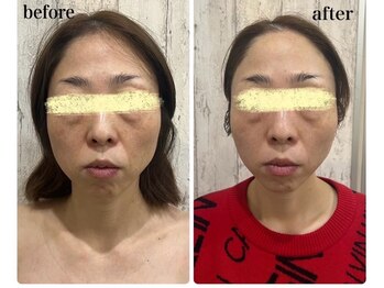 リリーガーデン 手稲店(Lily Garden)/ビフォーアフター 小顔/むくみ