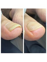 ラリベルテ(La liberte)/巻き爪カット