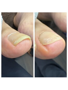 ラリベルテ(La liberte)/巻き爪カット