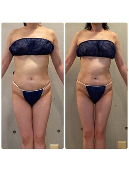 エクセレントビューティーサロン 艶(EN)/減量プログラム　6kg減量　