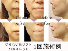 韓国式最先端切らない糸リフトでリフトアップ/小顔/美肌が叶う！