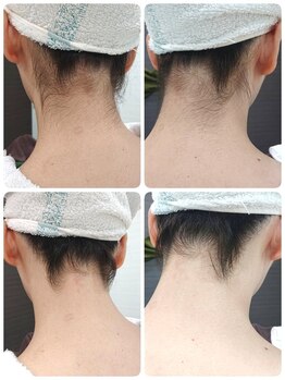 エステシェービングサロン フルール(Fleur)/うなじのシェービング