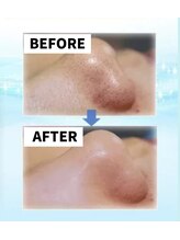 ミルトゥ(myrte)/KEANAKEREI　お鼻の黒ずみ・毛穴