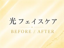 エルミューノ(elμno)/ここから光フェイスケア症例です