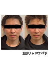 美バリサロン &nbsp;天神店/エアバリフェイシャル