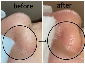 毛穴専科/韓国肌管理◇ 学割u24あり