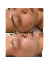 ウィズ(with)/REVIハーブピーリング×デコルテ