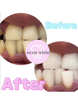 エクシアホワイトニング 倉敷店/ホワイトニングビフォーアフター