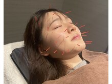 もりわき骨盤鍼灸整骨院 梅田院の雰囲気（【美容鍼灸】あなたのお悩みに合わせて施術します♪）