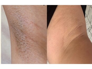 ルルトウキョウ 池袋店(LULU.tokyo)/ワキ脱毛/1回目→6回目