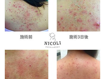 ニコリ(NICOLI)/ボディ/ハーブピーリング