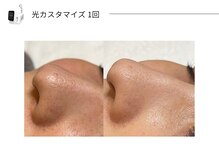 スパレーカ(Spa laka)/光カスタマイズ