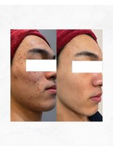 アルル 甲賀(ARuru)/ワンランク上のお肌改善を！